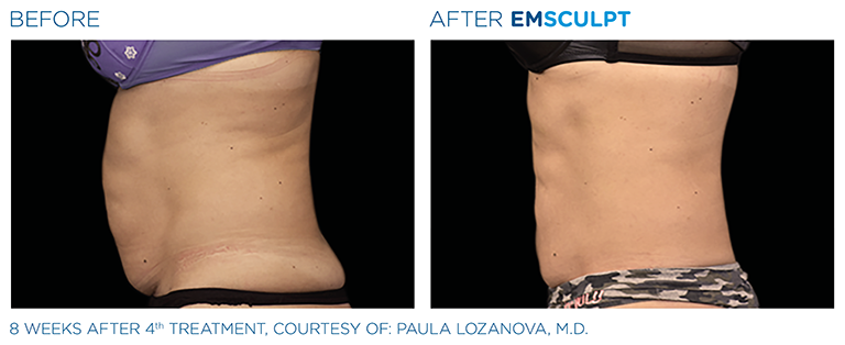 What Is EMSculpt? What to Know About the Body-Contouring Treatment