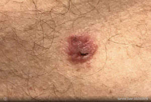 Basal Cell Carcinoma