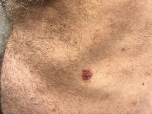 Basal Cell Carcinoma