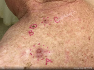 Basal Cell Carcinoma