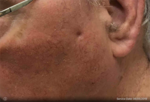 Basal Cell Carcinoma