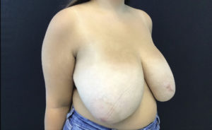 Breast Reduction