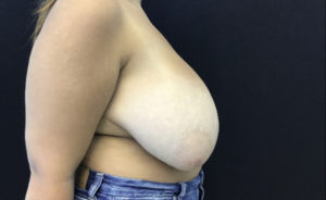 Breast Reduction