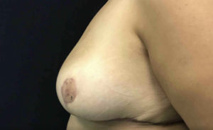 Breast Reduction