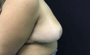 Breast Reduction