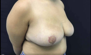 Breast Reduction