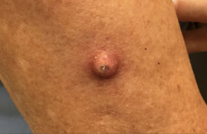 Basal Cell Carcinoma