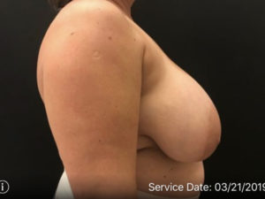 Breast Reduction