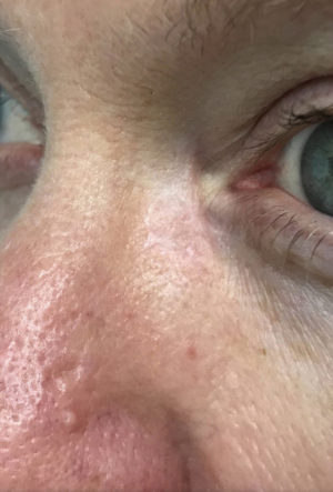 Basal Cell Carcinoma