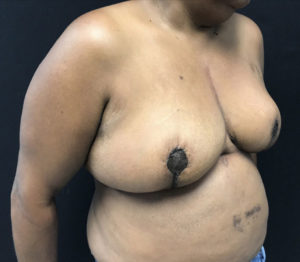 Breast Reduction