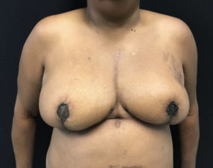 Breast Reduction