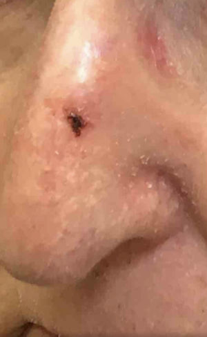 Basal Cell Carcinoma