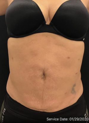 Liposuction