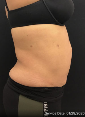 Liposuction