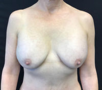 Breast Lift