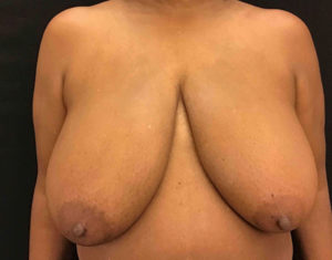 Breast Reduction