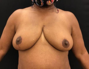 Breast Reduction