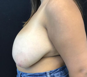 Breast Reduction