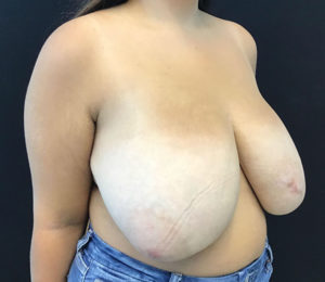 Breast Reduction