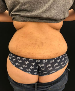 Liposuction