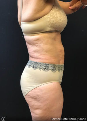 Liposuction