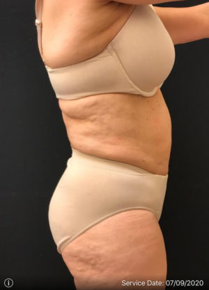 Liposuction