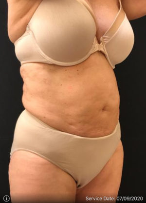 Liposuction