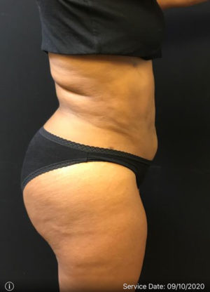 Liposuction