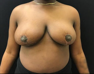 Breast Reduction