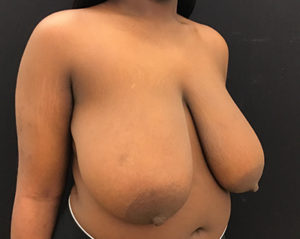 Breast Reduction