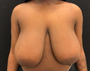 Breast Reduction