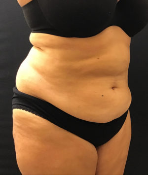 Tummy Tuck