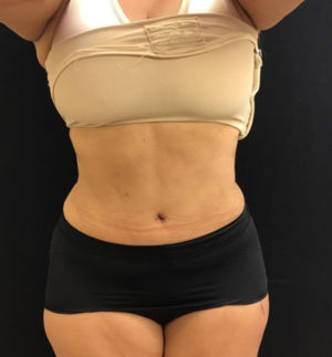 Tummy Tuck