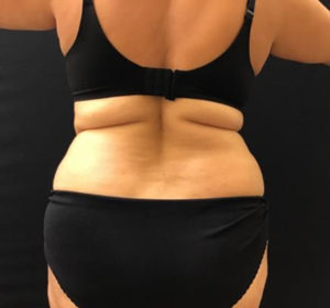 Tummy Tuck