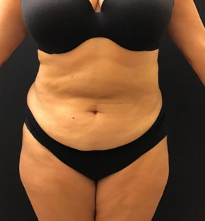 Tummy Tuck