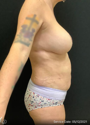 Breast Lift