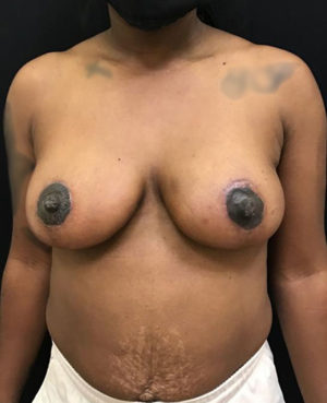 Breast Lift