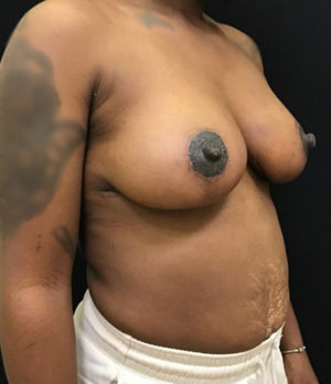 Breast Lift