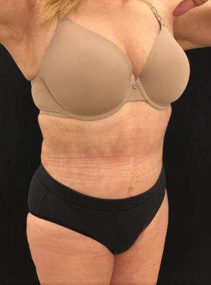 Liposuction