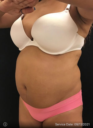 Liposuction