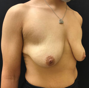 Breast Lift