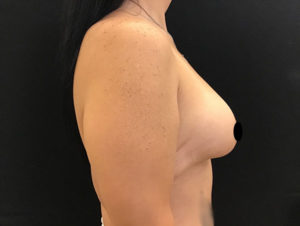 Breast Implant Removal