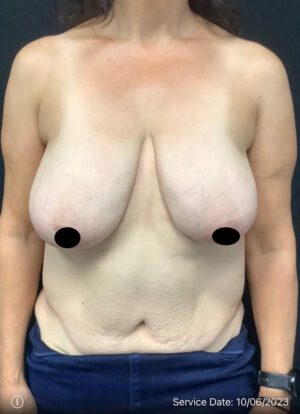 Breast Lift