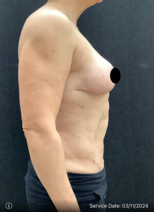 Breast Lift