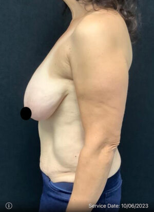 Breast Lift