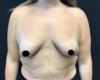 Breast Augmentation