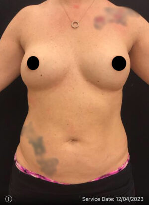 Breast Implant Removal