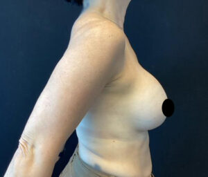 Breast Implant Removal