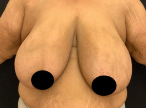 Breast Reduction