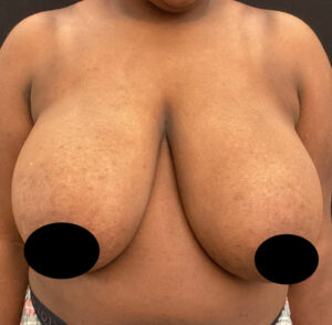 Breast Reduction